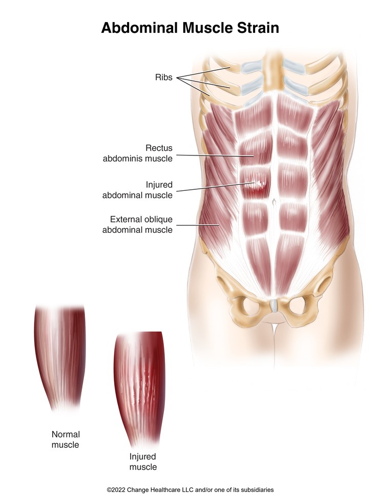 Abdominal Muscle Strain: Illustration