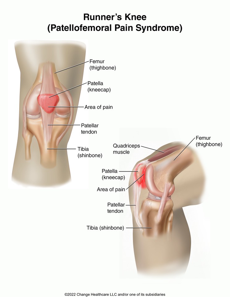 Runner’s Knee (Patellofemoral Pain Syndrome): Illustration
