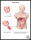 Thumbnail image of: Appendicitis: Illustration