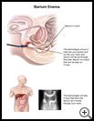 Thumbnail image of: Barium Enema: Illustration
