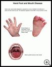Thumbnail image of: Hand, Foot, and Mouth Disease: Illustration