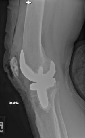 Xray
